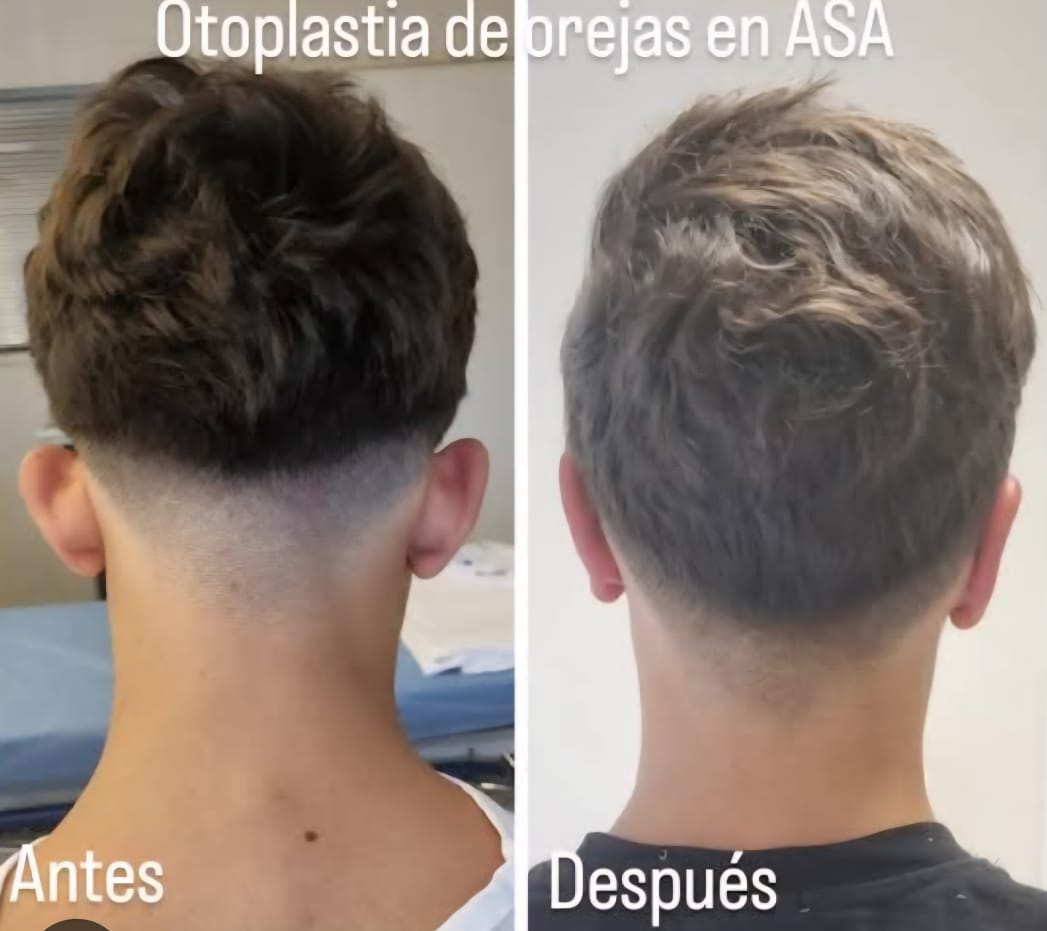 Resultado Otoplastia 6